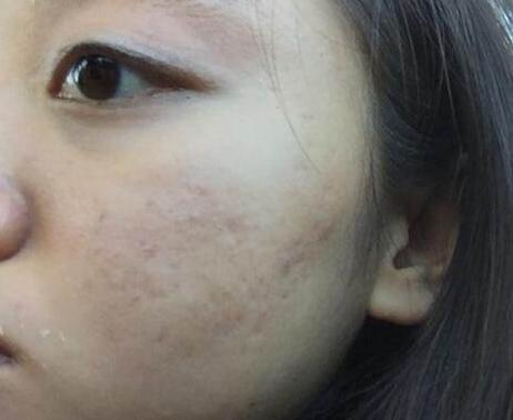 怎么祛痘印最快最有效的方法,如何快速祛痘印最有效的方法