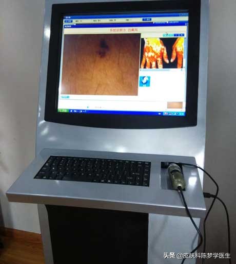 激光点痣真的会导致痣发生癌变吗,脸上有痣能激光点痣吗