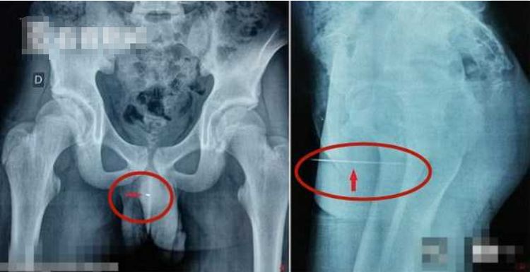 14岁男生把9厘米缝衣针插入尿道，痛苦三天去就医，网友：爽吗？