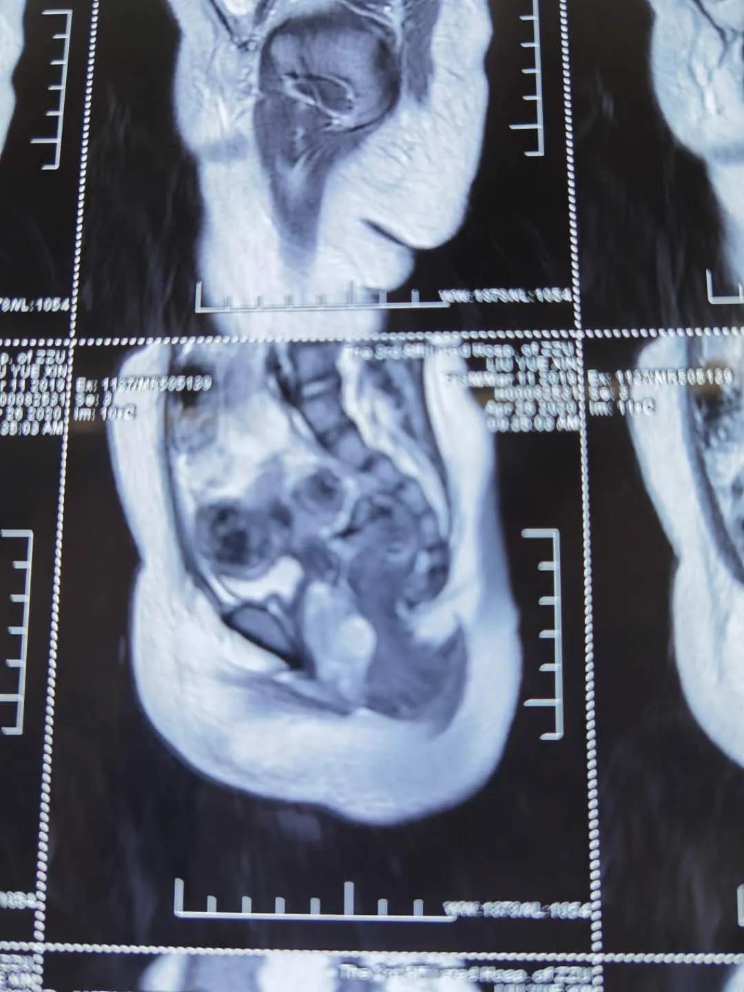 孩子卵巢恶性肿瘤,女童常见的妇科肿瘤