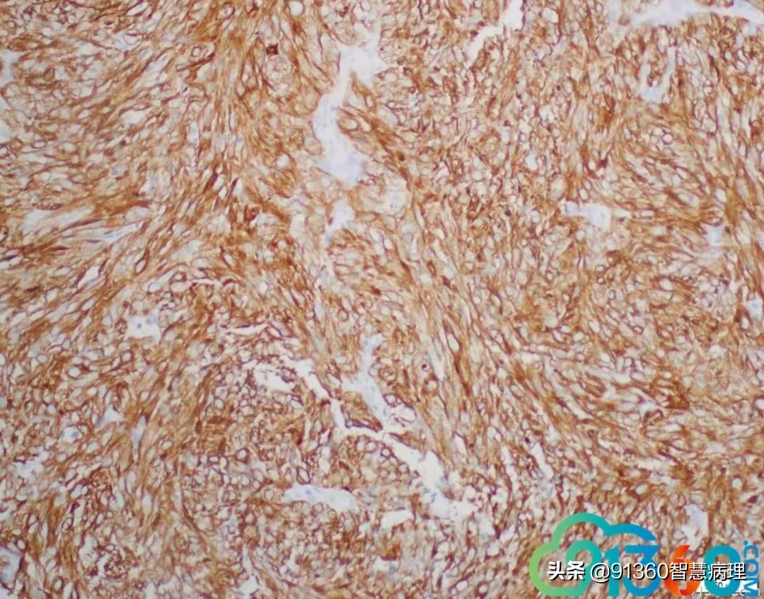 宫颈腺癌silvaa型用化疗吗,宫颈腺癌silvab型需要放疗几次