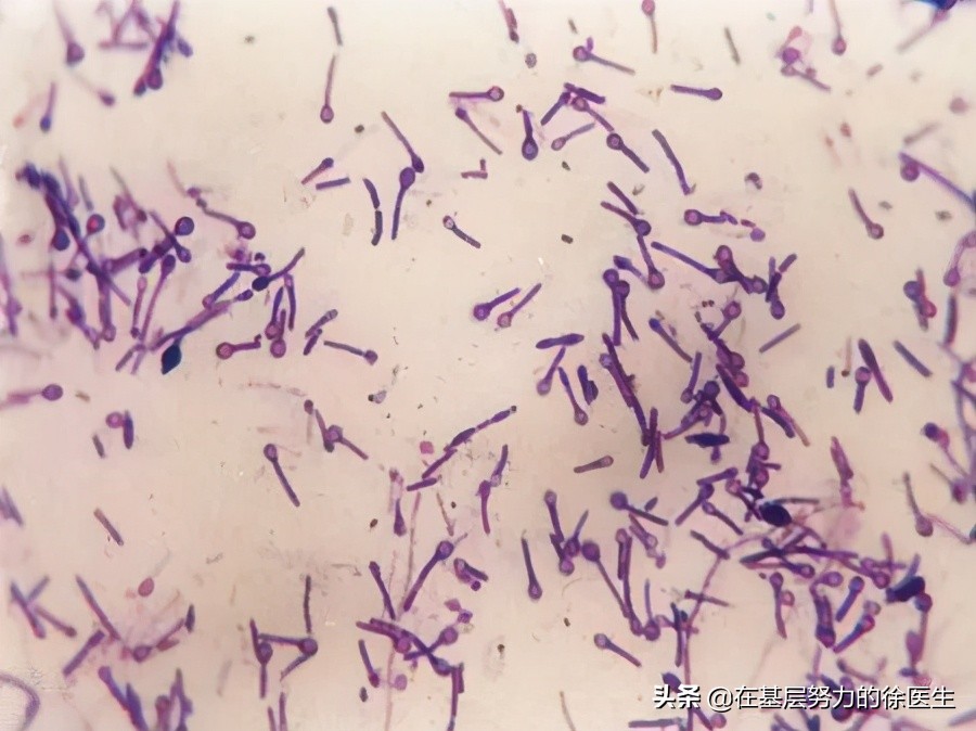 破伤风多久犯病,破伤风的潜伏期