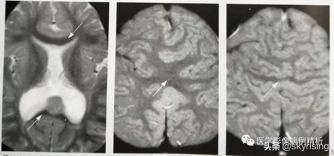 半叶全前脑畸形,无叶型前脑无裂畸形超声表现