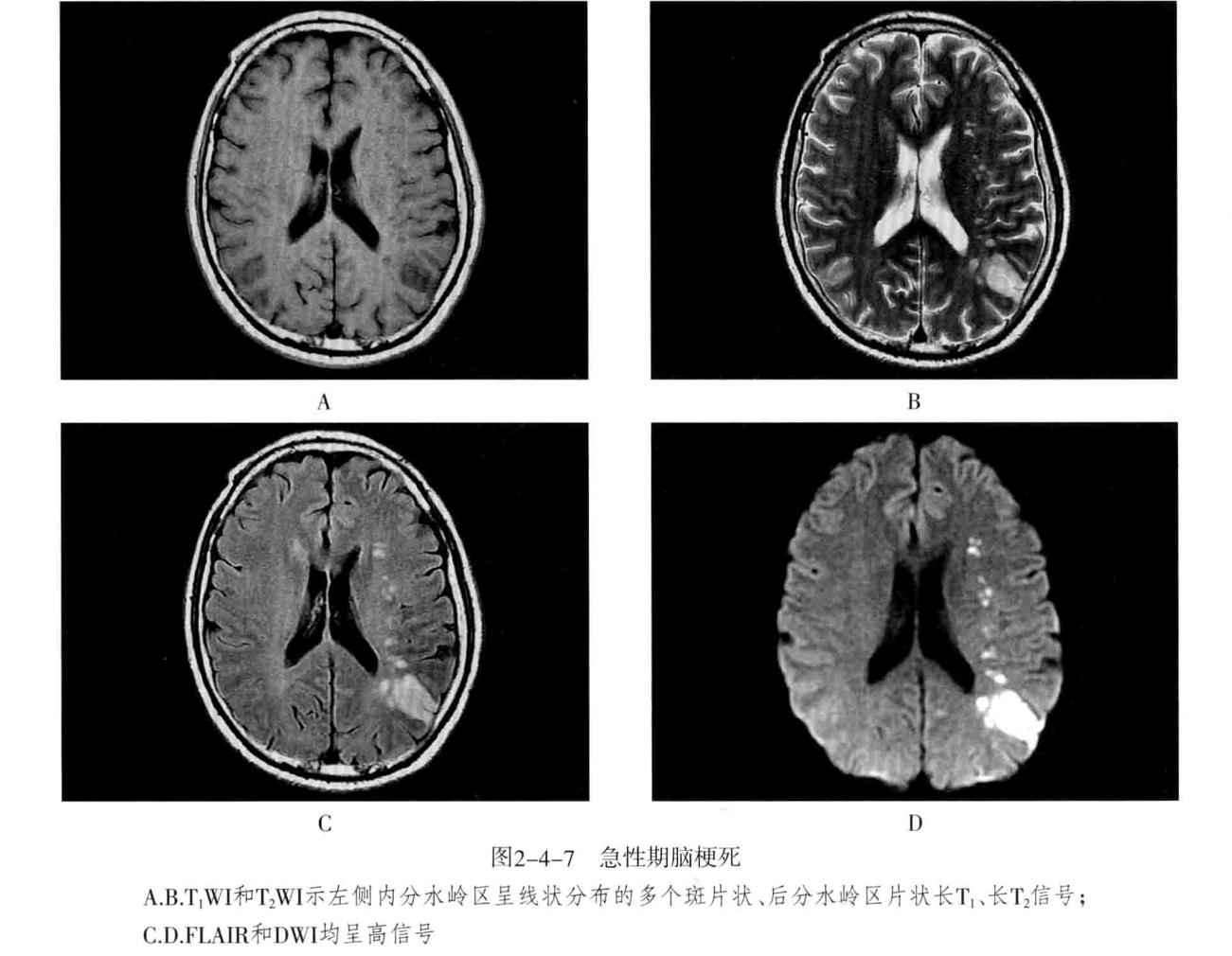 颅内血管周围间隙的影像鉴别,颅脑血管源性疾病影像诊断
