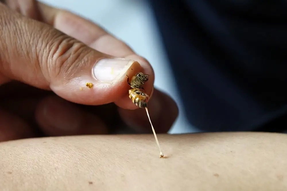 被马蜂蛰伤就医,被马蜂蛰伤休克