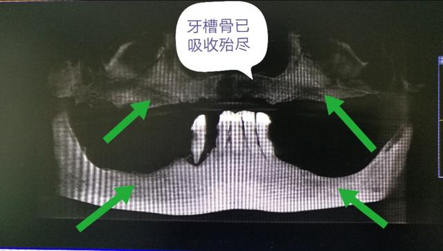 年轻人什么情况会牙齿掉光,30多岁牙齿掉光了是什么造成的