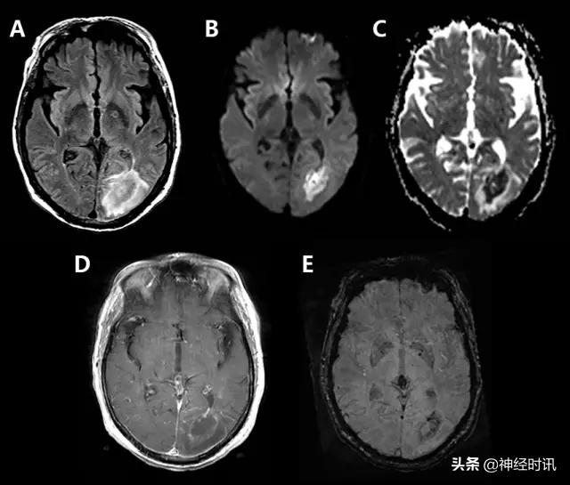 脑卒中病历诊断书图片,脑卒中影像判断技巧图解电子版