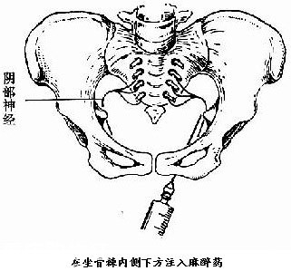 顺产什么情况会被侧切,顺产时候啥情况会引起大出血