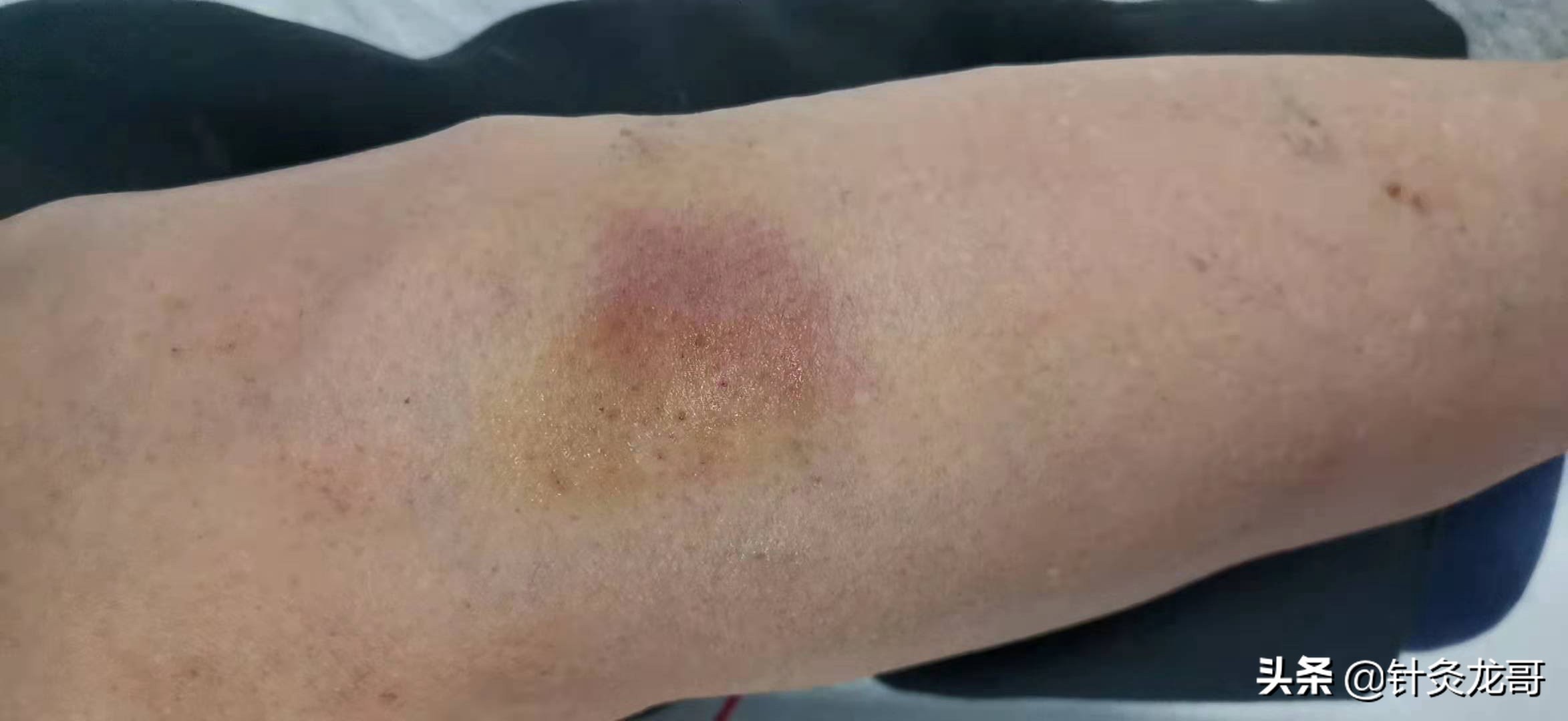 针灸出现淤青怎么办?会影响疗效吗?