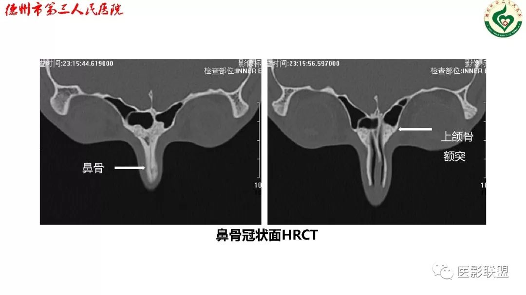 鼻骨骨折影像,鼻骨骨折dr影像表现