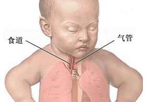 胃食管反流病健康小知识,食管异物的健康宣教