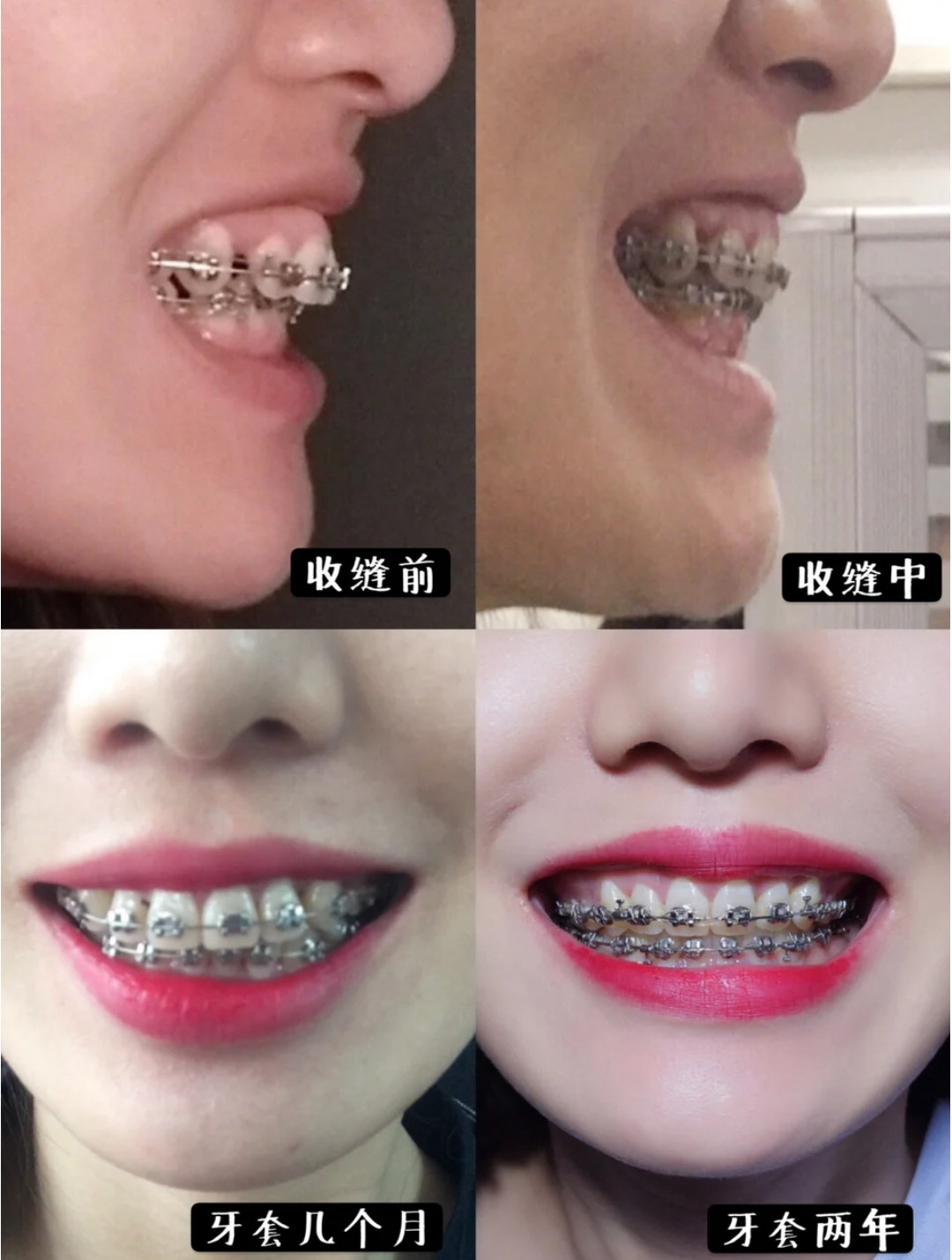 整牙过程超治愈,整牙全过程解说