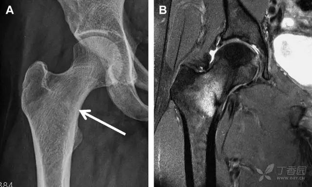 放射科夜班病例大全,放射科容易漏诊的骨折