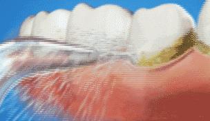 牙齿正面有小黑点千万不要忽视,不要小看牙齿的小黑点