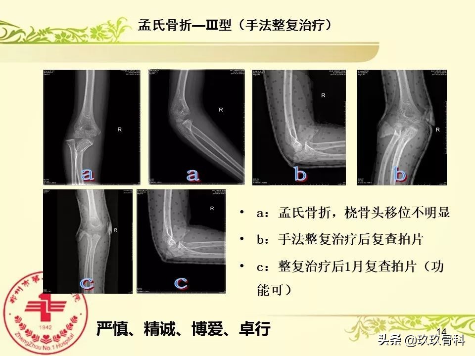 孟氏骨折功能训练多久能恢复正常,孟氏骨折中医能治吗