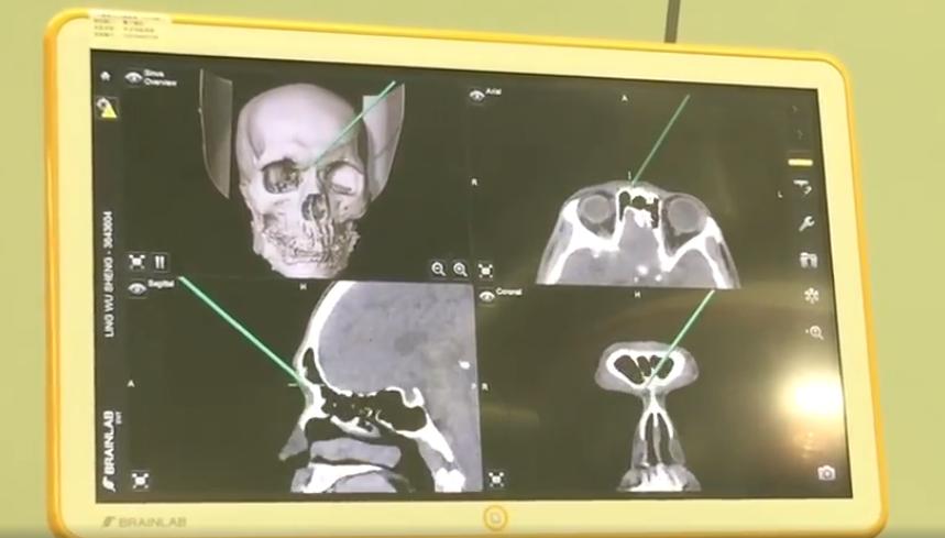 眉弓多高最合适,眉弓怎么判断高低