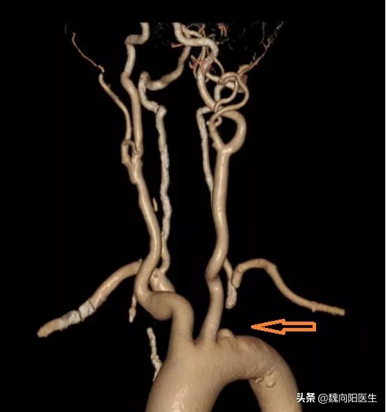 血压左高右正常是高血压吗,两侧血压值相差40有什么危险吗