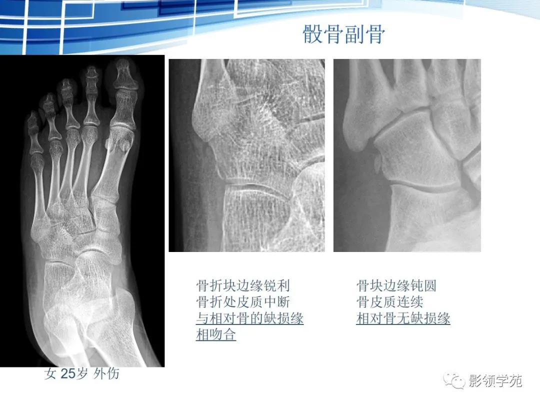 桡骨远端骨折引起尺骨变异,撕脱骨折一个月无明显骨痂形成
