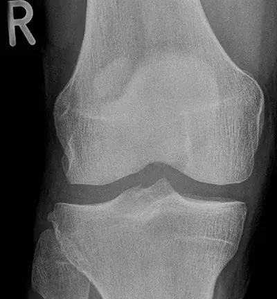 运医专家谈|走路没啥感觉，一跑步小腿迎面骨就疼，这是咋回事？