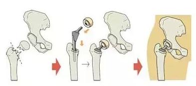 女性髋关节发育不良康复训练,35岁先天性髋关节发育不良修复术