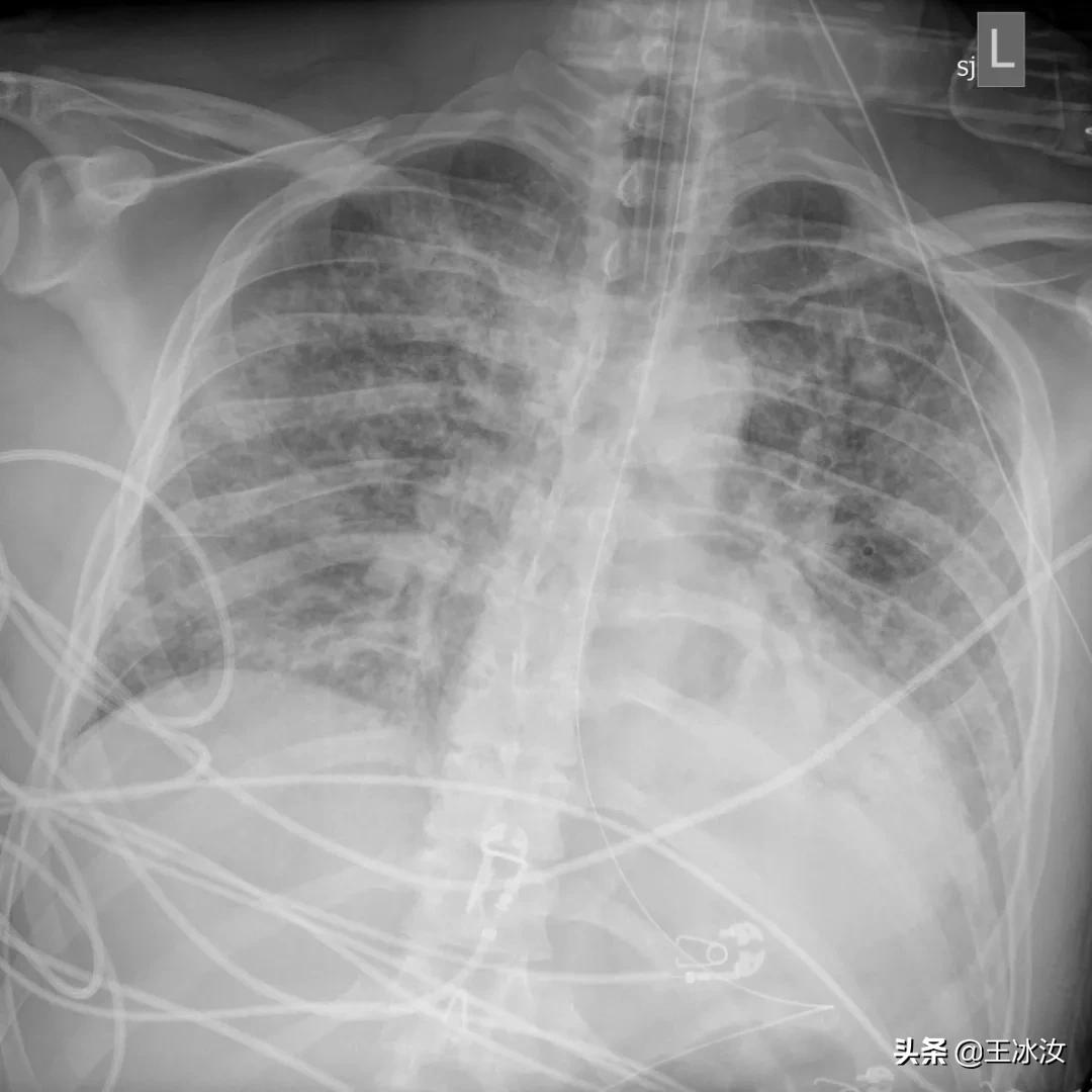 新冠特效药瑞德西韦最新消息,瑞德西韦新冠药