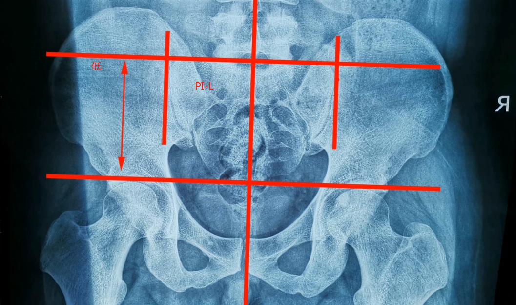 正骨矫正骨盆视频,正骨整脊矫正视频教程