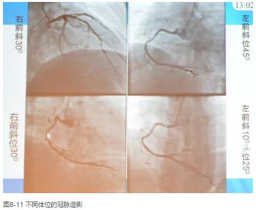 清晰完整揭秘冠脉造影全部过程,冠脉造影教学视频