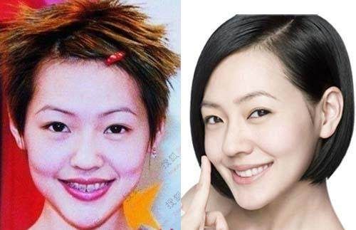 明星牙齿矫正过的图片对比,明星的牙齿怎么都是全部整的吗