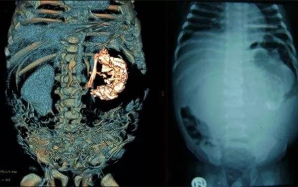 小女孩肚子里长畸胎瘤的原因,14岁女孩长出胎瘤