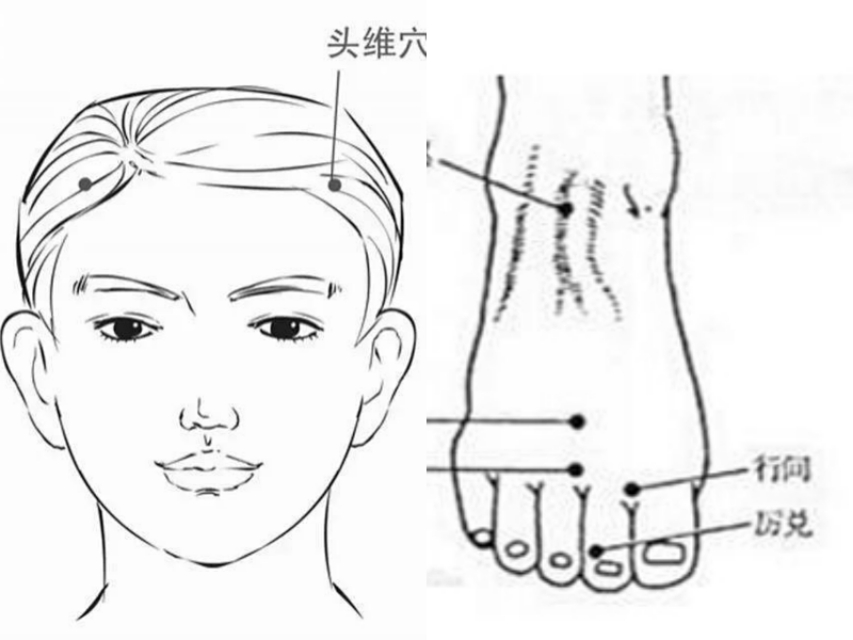 北中医于书庄针头维、历兑并合阿是穴火针点刺治血管收缩性头痛案