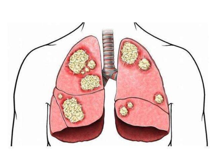 肺癌特效药哪里拿,肺癌特效药每个月都要吃吗