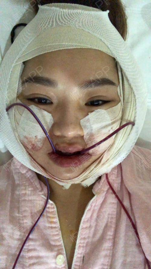 那些一刀切削骨的明星还好吗？后遗症一大堆，小方脸成最大赢家