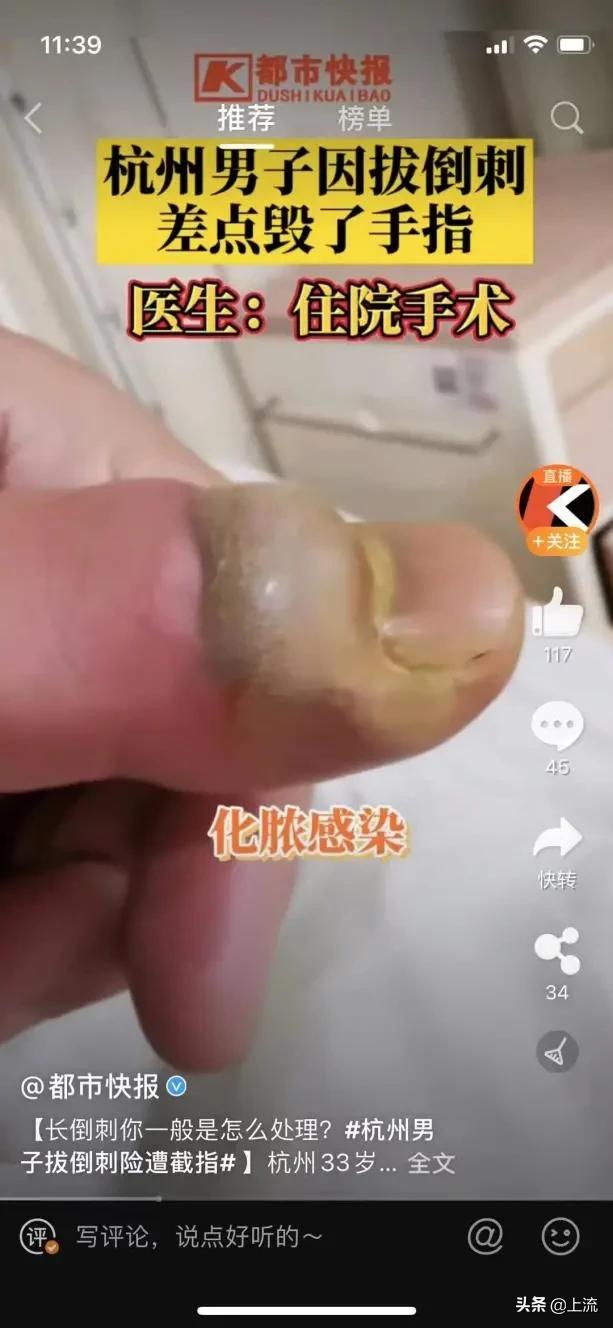 为什么拔倒刺会觉得舒服,忍不住拔手上倒刺怎么办