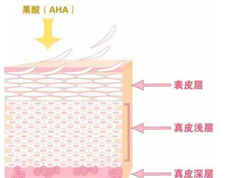 果酸换肤对哪种痘坑有效,果酸换肤对脂肪粒有效吗