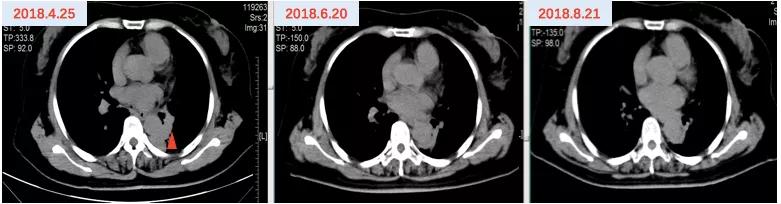 口服长春瑞滨出现耐药性了,口服长春瑞滨要吃多久
