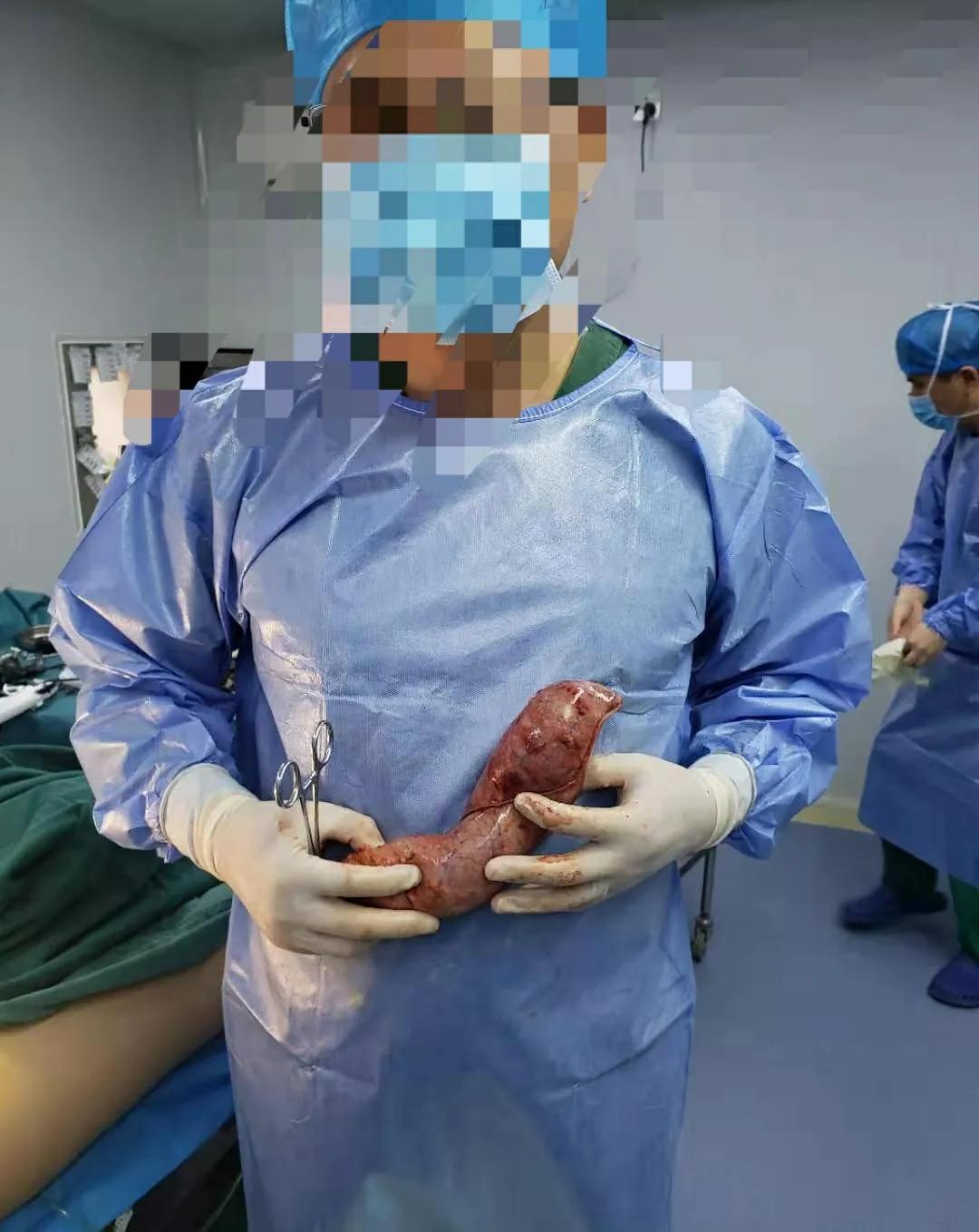 切胃减肥手术后遗症有哪些,切胃的人后来都怎样了