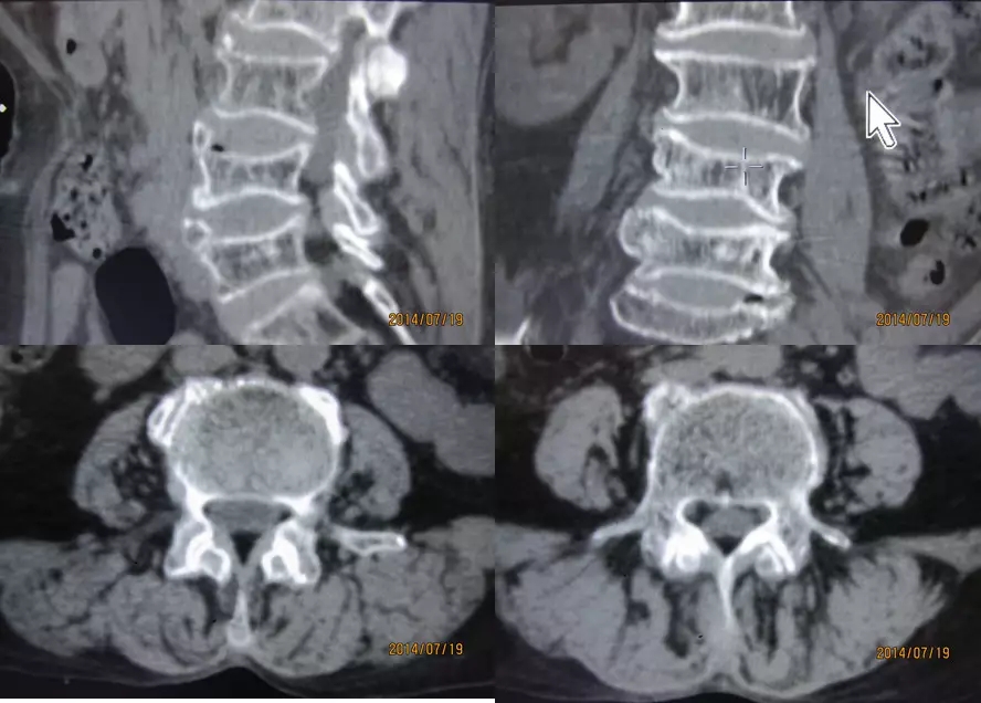 颈椎腰椎疾病ct及mri诊断,腰椎ct可以发现肠部病变吗