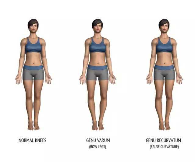 怎么改善又短又粗又不直的腿,小孩腿型矫正十种让腿变直的方法