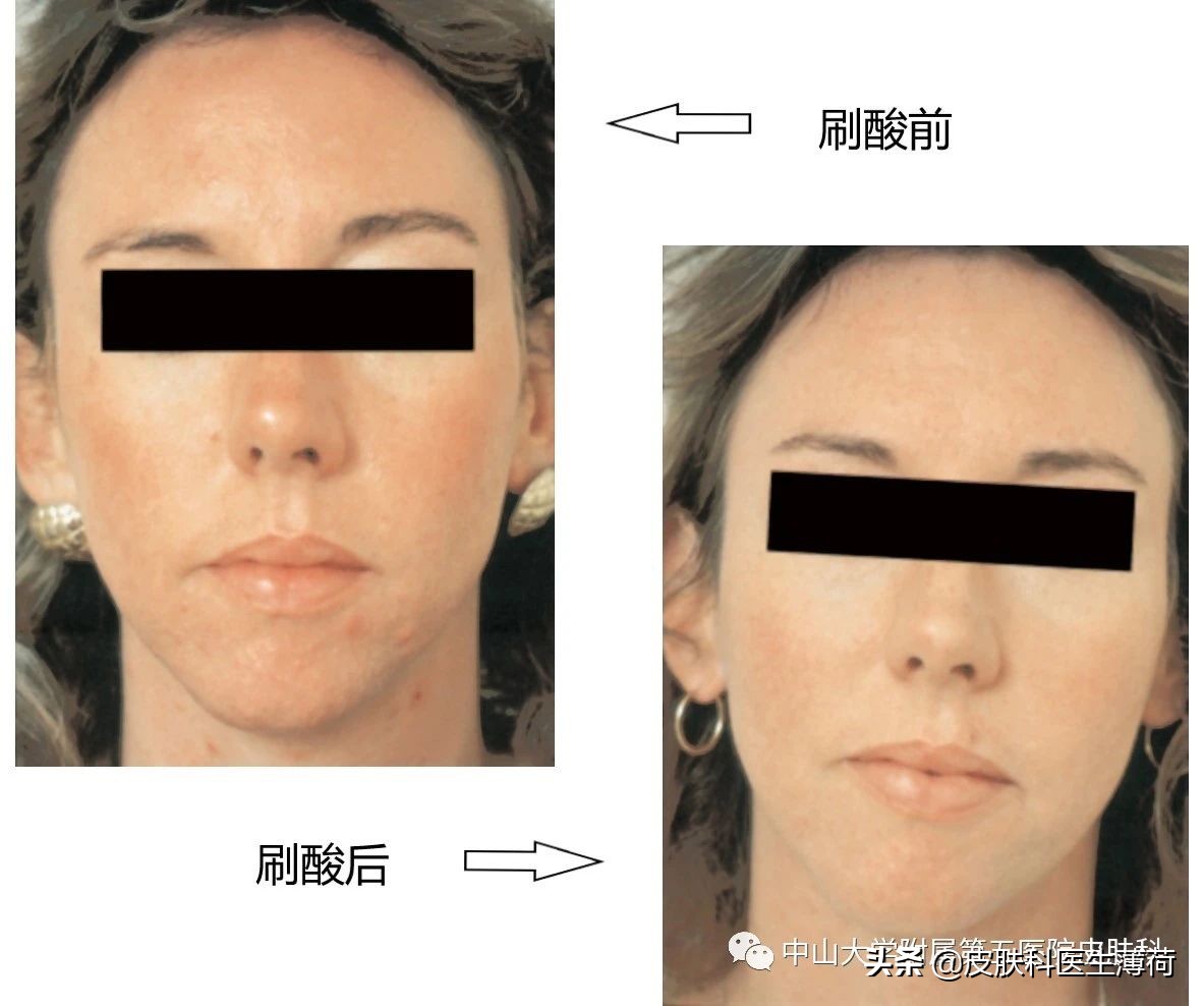 果酸换肤医生讲解,医生不会告诉你的秘密水杨酸