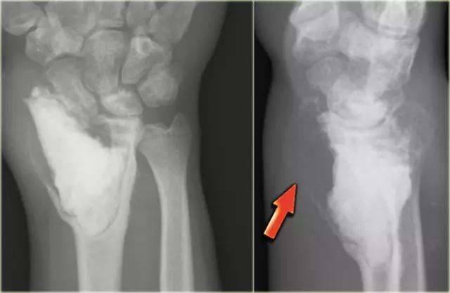 9种骶骨肿瘤,溶骨性恶性肿瘤