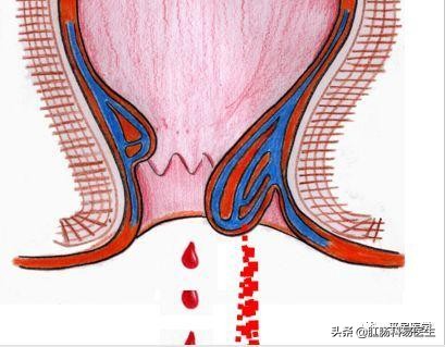 直肠炎有什么症状和表现呢,直肠炎简介