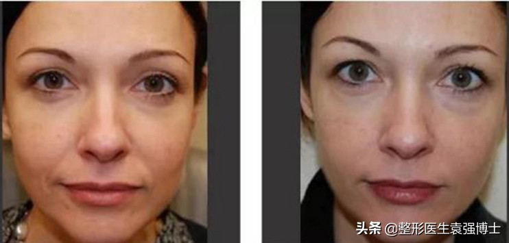 这3种方法解决法令纹效果很惊艳,这3个方法帮你去除法令纹