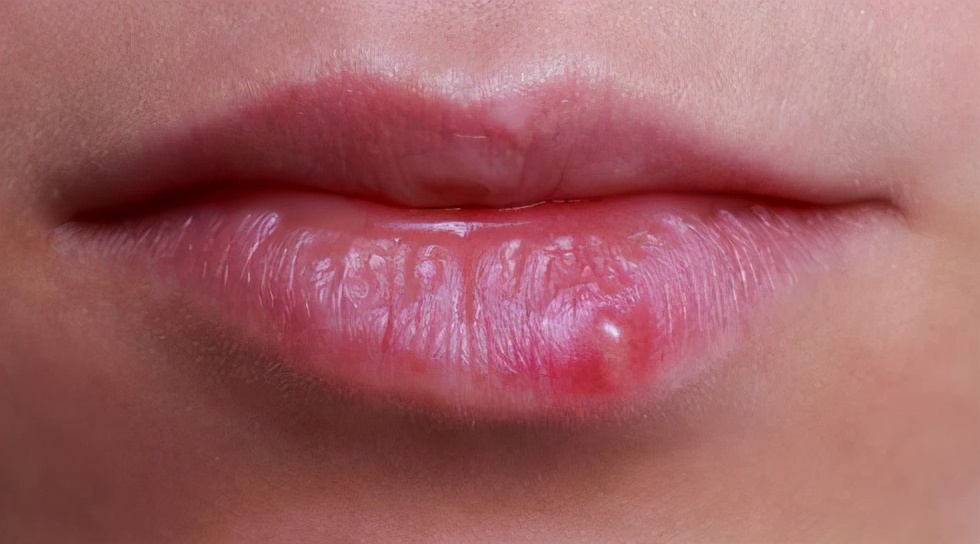 嘴上老是起泡与hpv病毒有关系吗,孕期感染hpv可怕吗