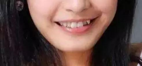 青春期如何把牙变白,青春期怎么让五官变好