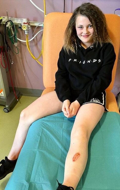 11岁女孩自己美甲胶水洒到牛仔裤上皮肤三度烧伤