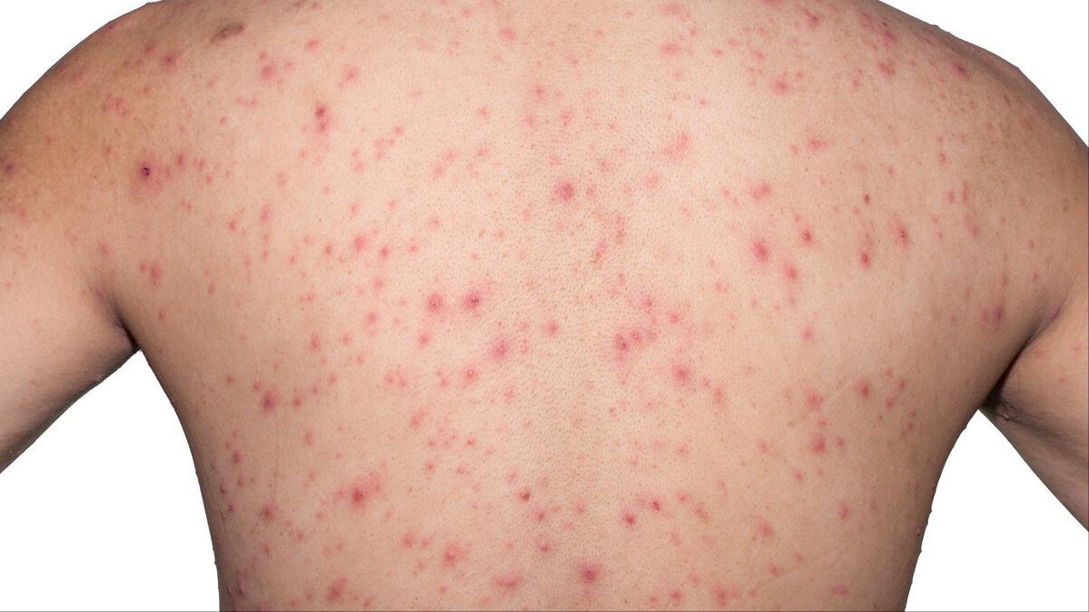 天生就有的鸡皮肤如何去除,鸡皮肤的人怎么去掉鸡皮肤