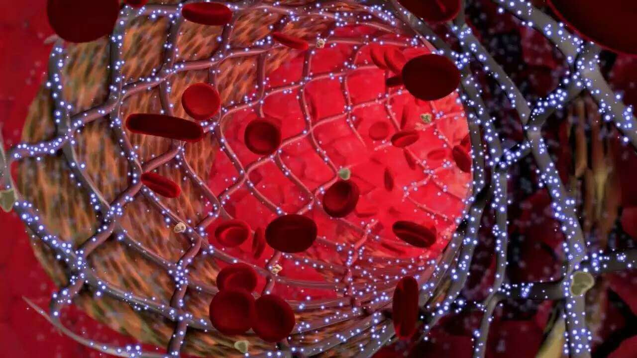 心脏放支架后应注意什么事项,安心脏支架站桩的注意事项