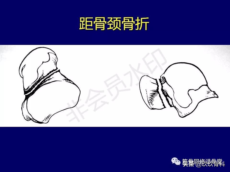 距骨骨折后遗症,距骨骨折怎么办