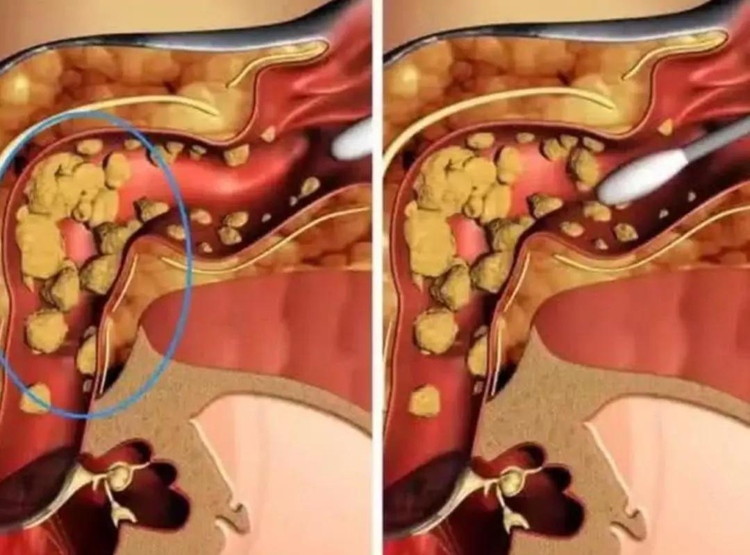 用棉签掏耳朵的危害动画,用棉签掏耳朵对身体有害吗