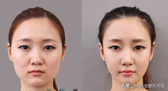 瘦脸针不要随便打,瘦脸针连续打几年真实感受